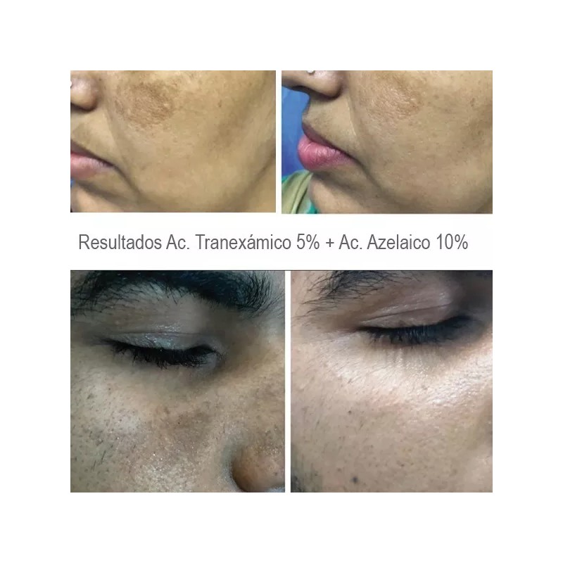 Dermaceutic Kit Booster Azelaico 10% + Tranexámico 5% Melasma Manchas