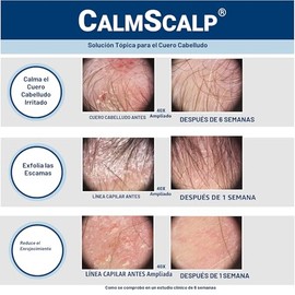 Sérum para el cuero cabelludo CalmScalp | Alivio de la picazón del cuero cabelludo | Tratamiento para el cuero cabelludo | Exfolia las escamas y las e