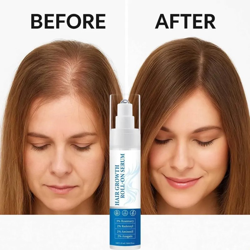Sérum De Romero Para El Crecimiento Del Cabello En Rollo,