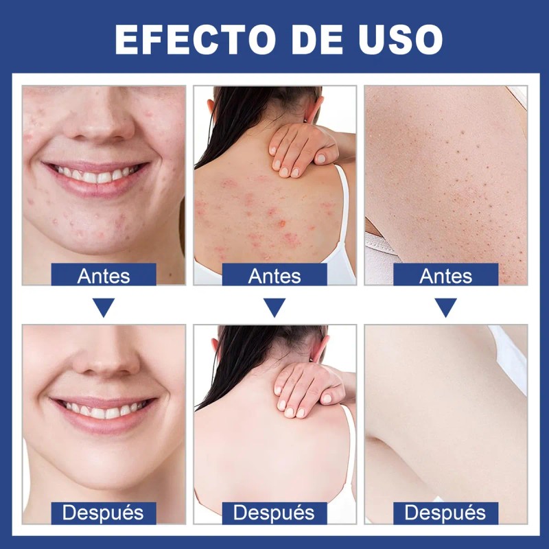 Sérum Antiacné Reductor De Espinillas Y Granos