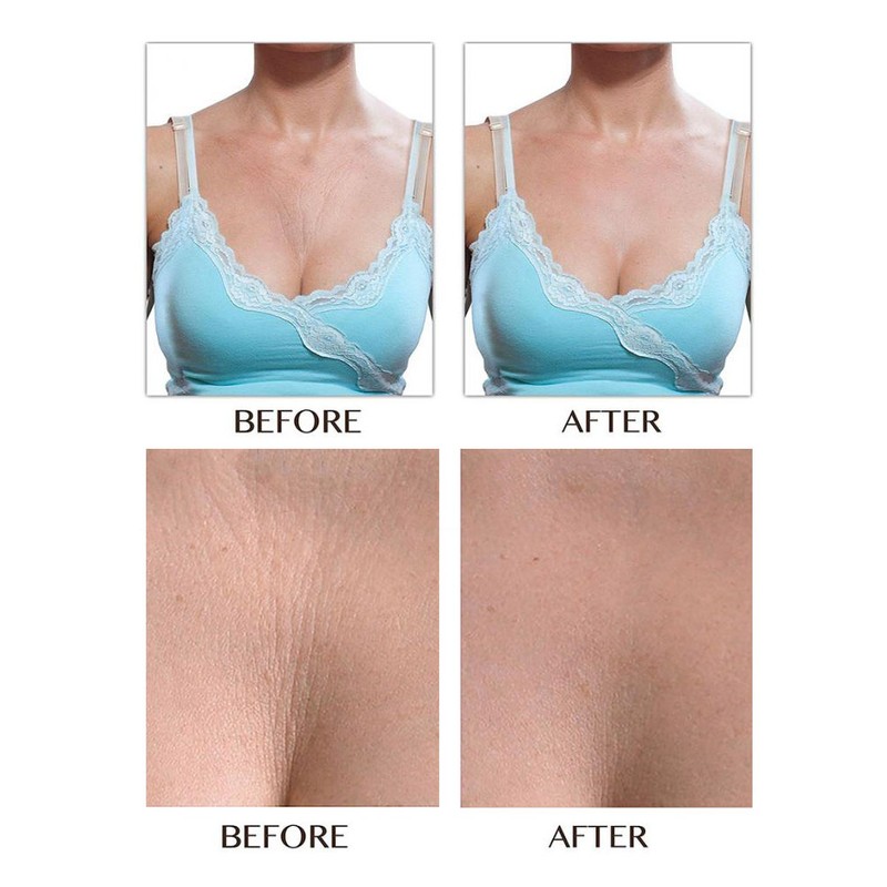Cleavage Pads T Shaped Anti Wrinkle Silicone Cleavage Pads Self