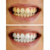Teeth Whitening Gel Syringe Dispensers 22% Carbamide Peroxide, 10 Tooth