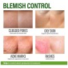 Crema Facial Para El Acné - Tratamiento Localizado Para El