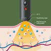 Herpotherm Heat Treatment for Cold Sores
