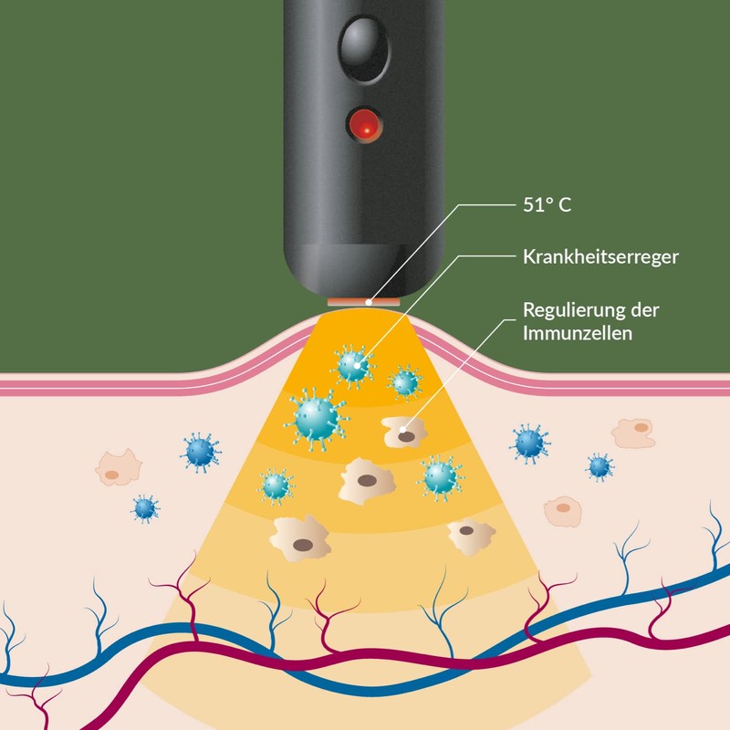 Herpotherm Heat Treatment for Cold Sores