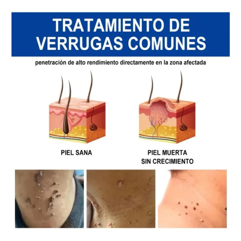 Líquido Mejorador De Verrugas Y Maíz Reva