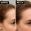Alphainfuse Hair Regrowth System – Advanced Hair Growth Treatment with