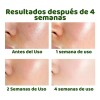 Tratamiento Antiacne Control Poros Manchas Espinillas 35ml