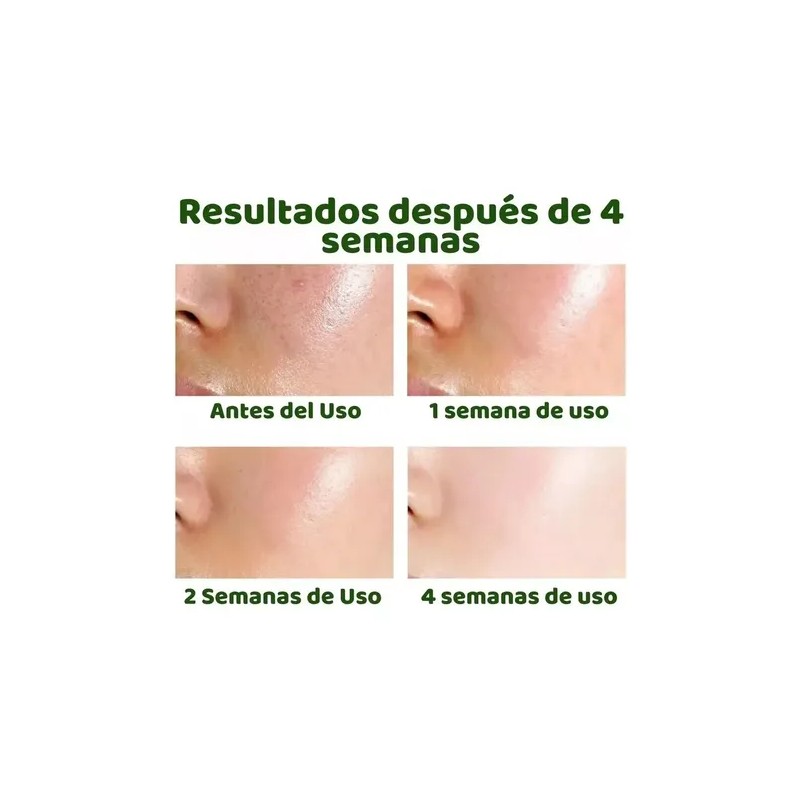 Tratamiento Antiacne Control Poros Manchas Espinillas 35ml