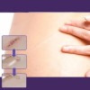 8 Parches Silicona Reutilizables Cicatrices Grado Medico F