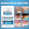 Crema De Tratamiento De Foliculitis, Eficaz Crema De Folicul