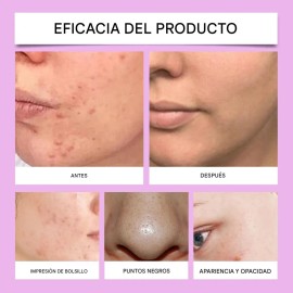 Mopoyat - Crema Para El Cuidado Del Acn Con cido Azelaico - Atena El Acn, Mejora El Enrojecimiento, Hidrata Y Nutre Suavemente                        