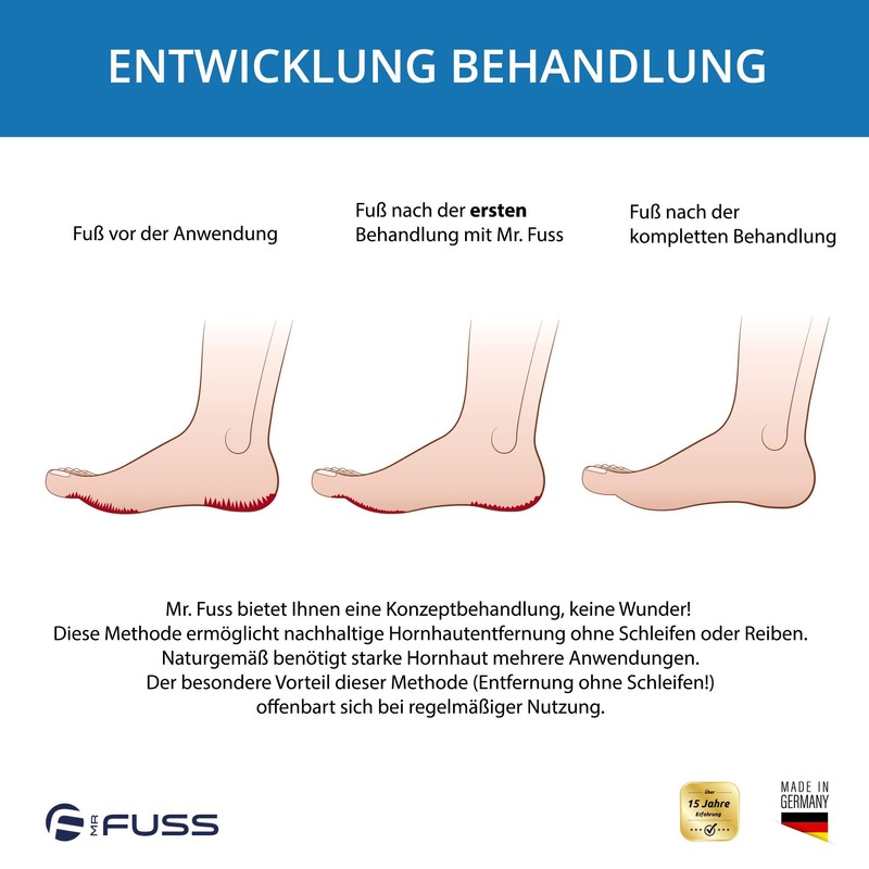 Mr. Fuss Starter Kit - 5 Pieces Callus Remover System