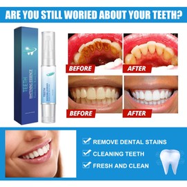 Rostblant Teeth Whitening Stick, Teeth Whitening Pen, Pain-free, Teeth Whitening Stains Removal, Teeth Whitening Essence Pen