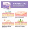 Veraly 24 Parches Acne Dia/ Noche Quita Acne Espinillas Tapa