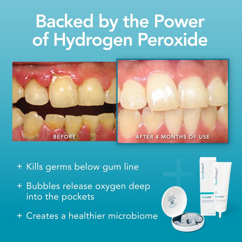 Perio Gel | Periodontal Treatment for Teeth | Promotes Teeth
