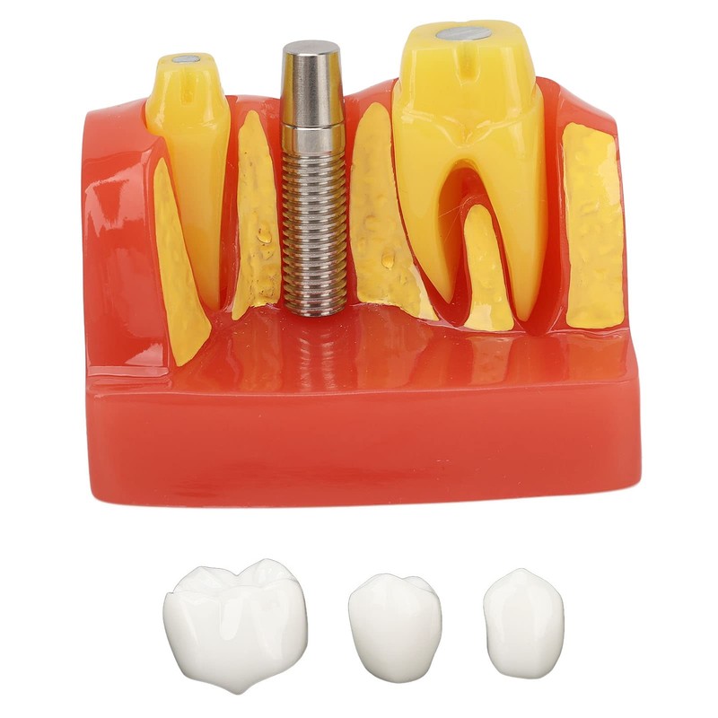 Dental Implant Teeth Model, Dental Implant Analysis Crown Bridge Model,