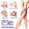 Varicose Veins Cream, Vein Ointment Varicose Veins Cream Against Spider