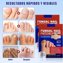 Parches de Cuidado para las Uñas，Parches Correctores para las Uñas de los Pies,PatchesIngredientes Naturales, Mejorar la Apariencia de las Uñas