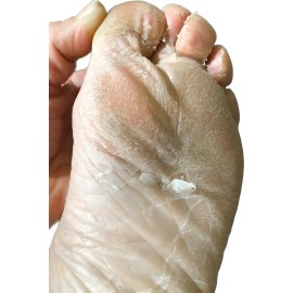 Crema Para Hongos 3 Pzs