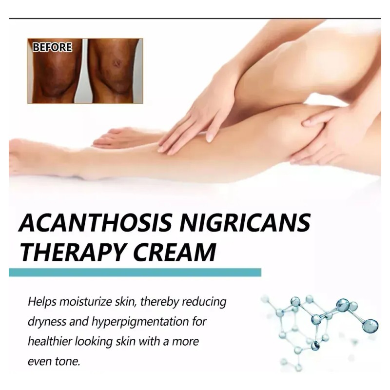 Fixderma Nigrifix Crema Acantosis Nigricans Fbgx2 Agua