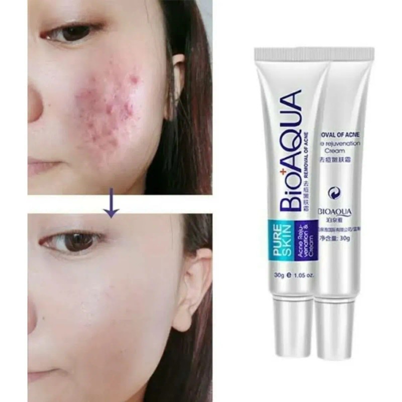 Bioaqua Acne Cream Reduce Cicatrices Poros Grasa Cuidado Continuo
