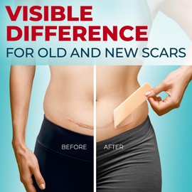 Medical Grade Silicone Scar Tape - 1.6”x60” - Visible Difference on Surgical & Keloid Scars - Reusable Silicone Scar Sheets - Easy to Use Silicone Tape for Scars