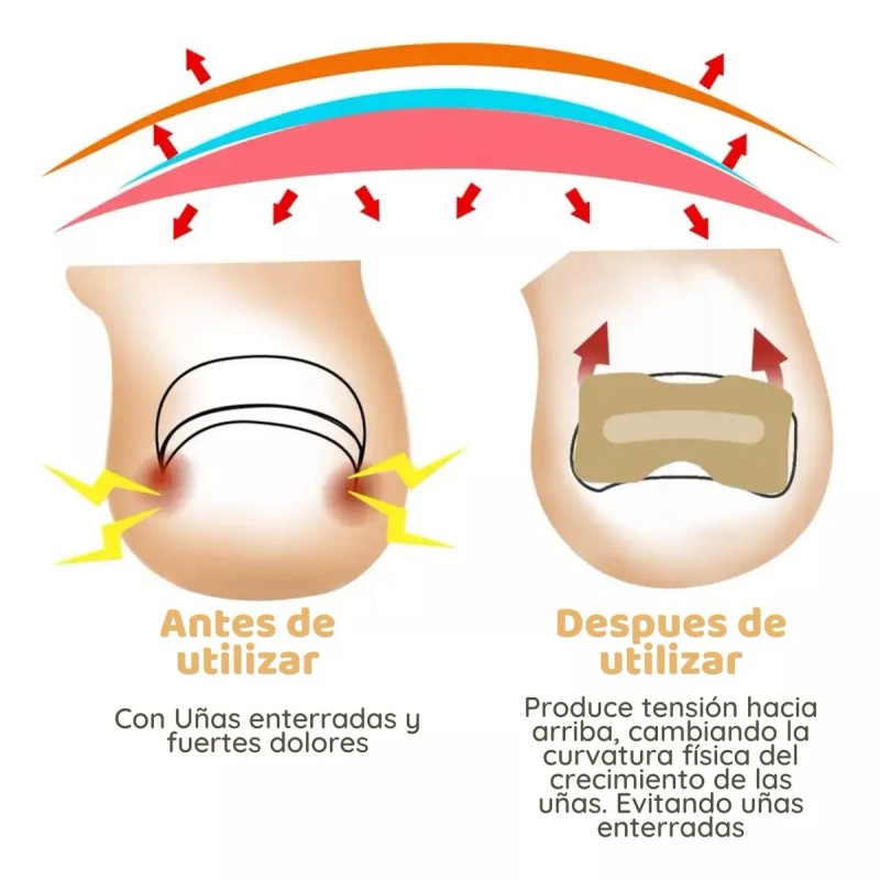 Universo en Linea 50 Parches Correctores Uñas Enterradas Uñeros Adhesivos