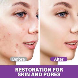 12% Azelaic Acid Serum, Azelaic Acid 12% Face Serum Against Redness, Anti Pimples and Nodules, Sensitive Skin Face, Azelaic Acid Serum, Azelaic Serum Against Acne, Dark Spots