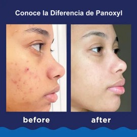 Harmei 2pcs Gel Limpiador Antiacné Panoxyl (156g*2) Benzoyl Peroxide 10%, Antibacterial Potente, Apto Para Rostro Y Cuerpo, Elimina El Acné Existente Y Ayuda A Prevenir Nuevos Brotes