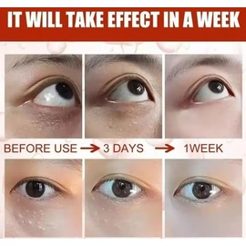 2 Crema Contorno de Ojos con Kojic Acid, Niacinamida, Retinol, Pro-Xylane, Antimanchas y Antiarrugas, 20g, 2 Piezas