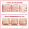 Crema Para El Acné Reduce Granitos Y Mejora La Piel