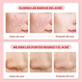 Crema Para El Acné Reduce Granitos Y Mejora La Piel 30g