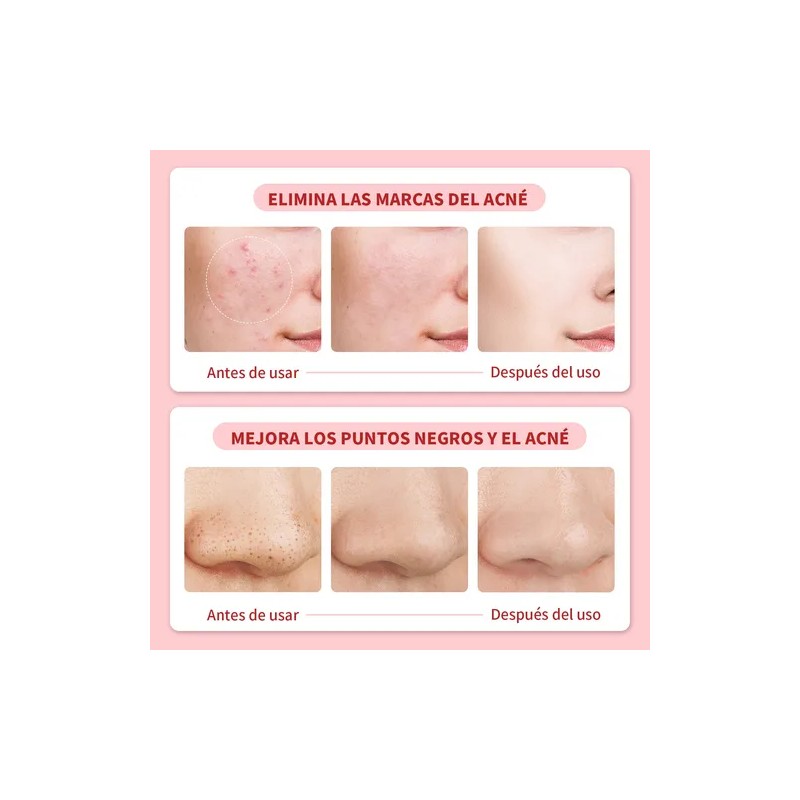 Crema Para El Acné Reduce Granitos Y Mejora La Piel