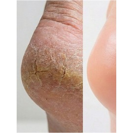 Scrabbit Foot Calluses Eraser Callus Softener + Stainless Steel Foot File + Foot Cream Set Smooth & Silky Foot Trio Calluses / 스크래빗 발각질지우개 각질연화제 + 스텐 풋 파일 + 풋 크림 세트 스무스 앤 실키 풋 트리오 발각질