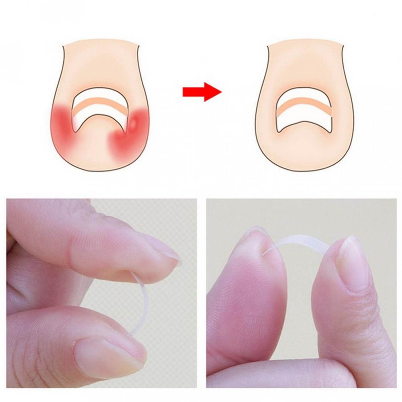 6 in 1 set Ingrown Toe Nail Fixer Pedicure Toenail
