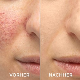 Vitayes Vitamin C Serum with Hyaluronic Acid, Highly Dosed, Vegan, Face Care, Eye Area, Anti-Wrinkle /Anti-Ageing, Anti-Pigment Spots, Suitable for Derma Roller, Organic Care Product