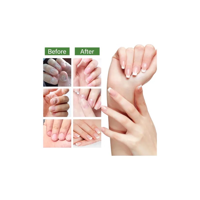 3pcs Suero Uñas Jengibre Cuidado Mopoyat