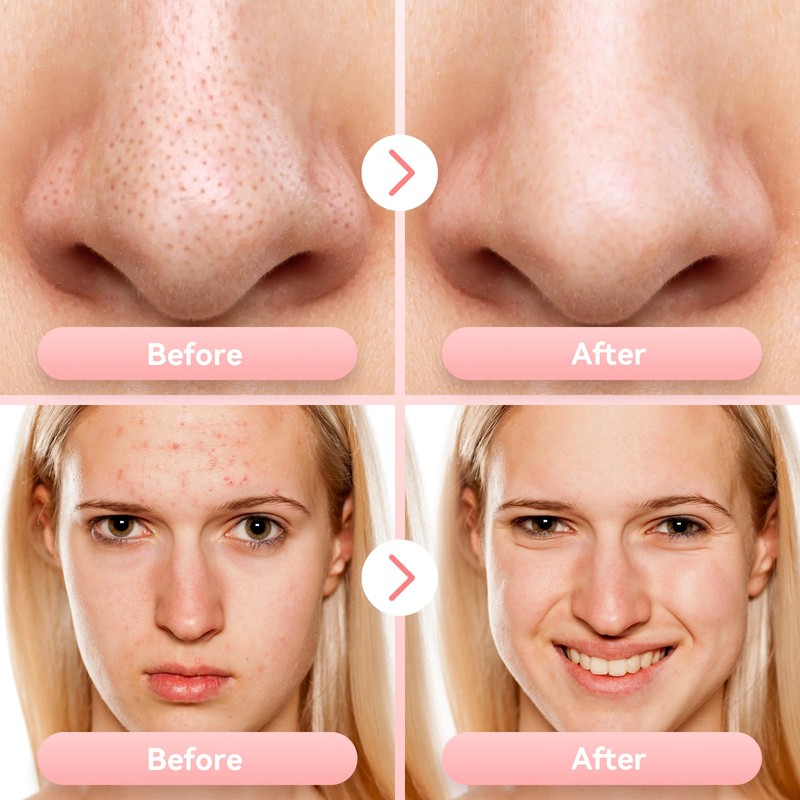 Blackhead Remover Pore Vacuum Upgraded Facial Pore Cleaner Electric Comedone