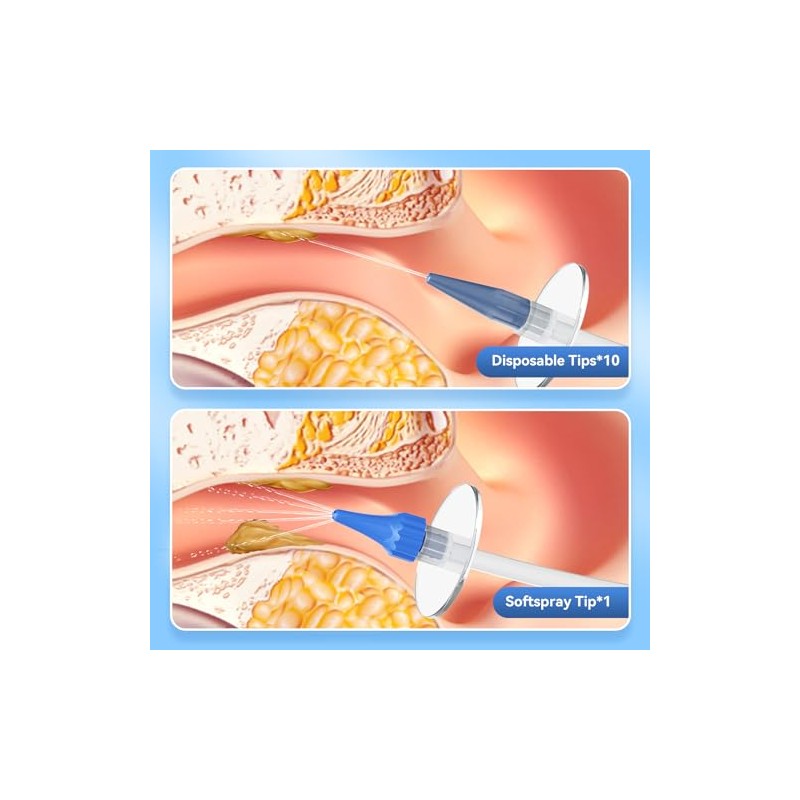 Qimic Ear Wax Removal Kit, Qimic Ear Cleaner, Ear Wax