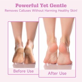 Electric Foot File – Adjustable Speed Callus Remover for Feet, Professional Pedicure Tool for Dead Skin & Calluses，for Home Use & Travel
