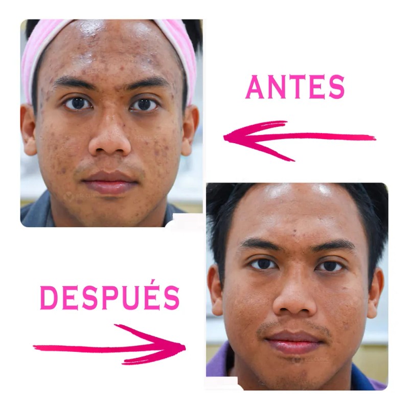 Crema Facial Concha Nacar + Jabón Leche De Burra, Aclarante