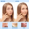 Blackhead Remover Tool Pimple Popper Tool Kit 5 Pack Blackhead