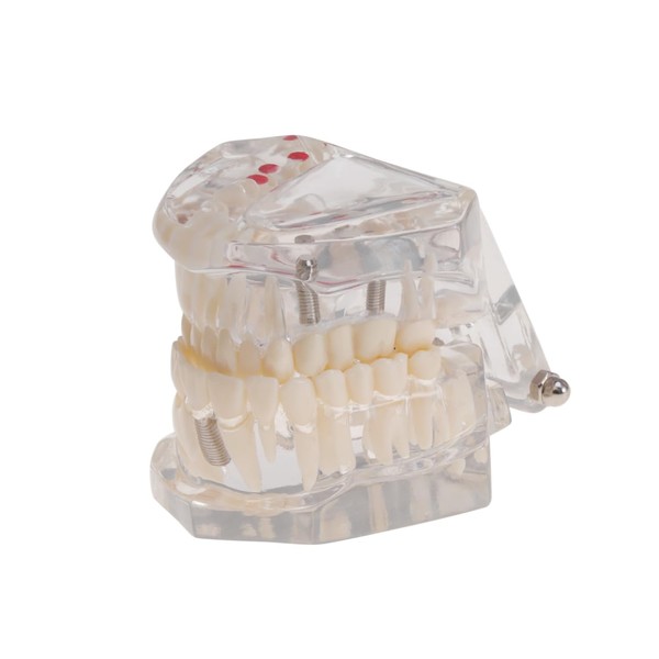 BUGUUYO Detachable Oral Model for Dental Teaching Removable Disease Teeth
