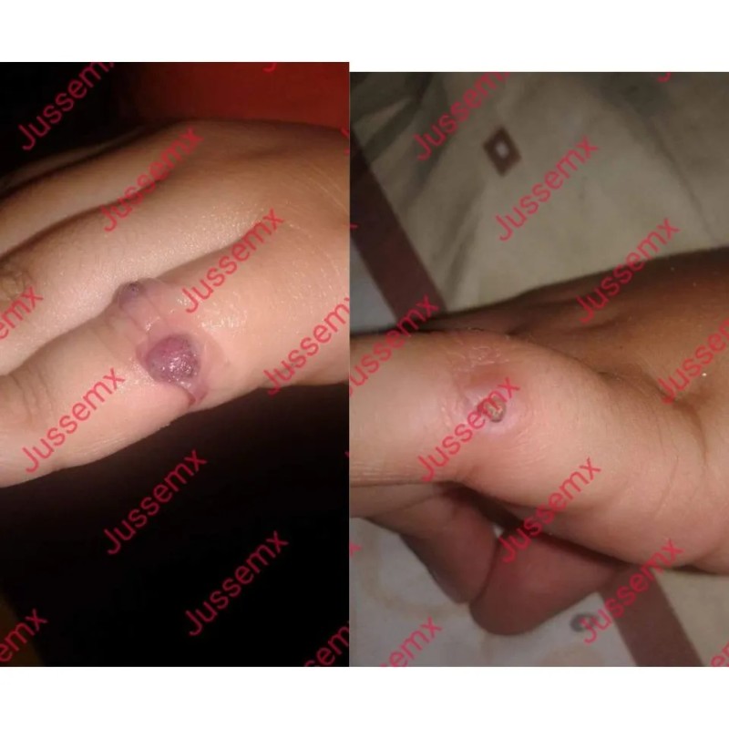 Jusse Anti Verrugas Lunares Mezquinos 15 Ml Sin Perfumar