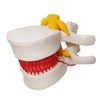 Human Herniated Disc Model, Anatomical Herniated Lumbar Vertebrae Disc Prolapse