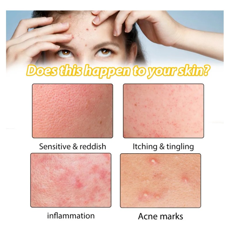 3×crema Para Tratar El Acné: Combate Acné Hormonal Quístico