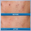 Cerave Gel Para El Control Del Acné, Tratamiento Con Ácido