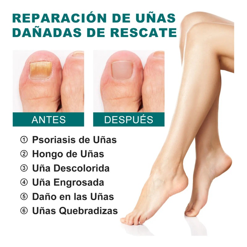 Crema Para Eliminar Hongos En Uñas De Manos , Pies