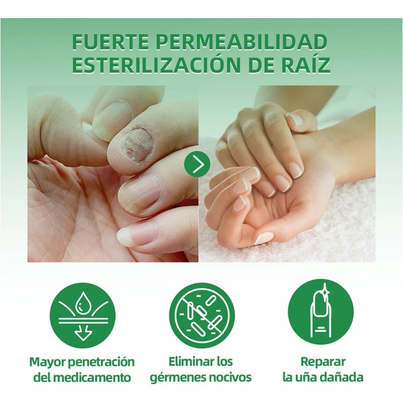 Líquido Para Hongos En Las Uñas-tratamiento Para Uñas